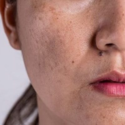 melasma